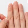 Brittle Nails