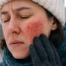 winter rash